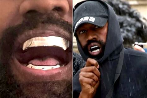 Kanye West Removes Teeth, Buys $1.3 Million Bond-Villain Titanium Dentures