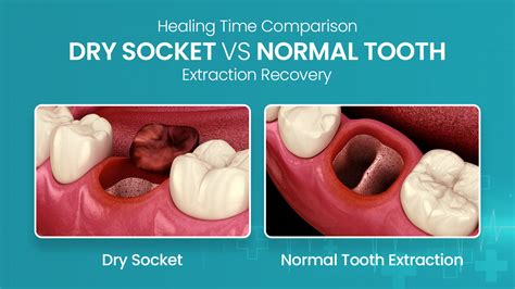 Recovery Time Of Dry Socket Vs Normal Tooth Extraction