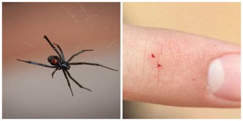 How to Identify a Spider Bite and Treat It - TruePrepper