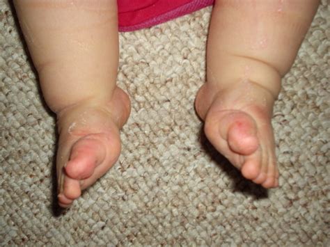 Congenital Talipes Equinovarus (Clubfoot) Nursing Care Management ...