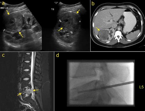 Renal cell carcinoma - Radiology at St. Vincent's University Hospital