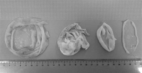 Hydatid cyst samples obtained from humans. | Download Scientific Diagram