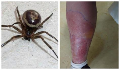 Black Widow Spider Bite Images / Common Spider Bite Symptoms Household ...