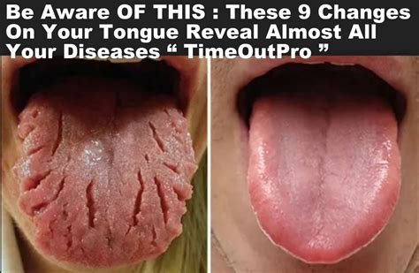 Be Aware Of THIS: These 9 Changes On Your Tongue Reveal Almost All Your ...