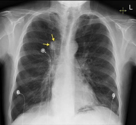 Chest X Ray Pneumonia Vs Lung Cancer - CancerWalls