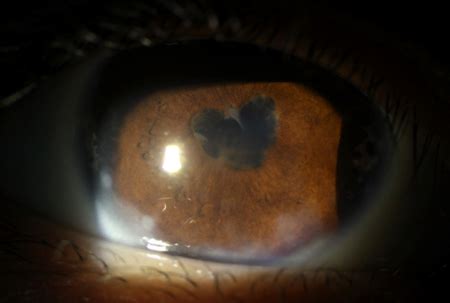 Ocular Synechiae: A Rare but Serious Eye Condition | OBN