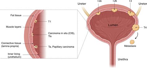 Frontiers | Treating Bladder Cancer: Engineering of Current and Next ...