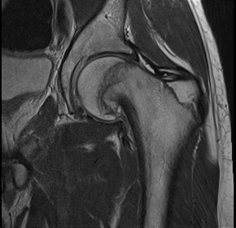 Normal Hip Mri