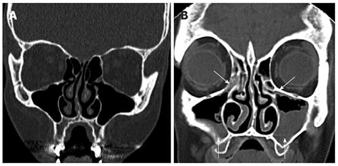 What Is A Ct Scan Of Sinuses