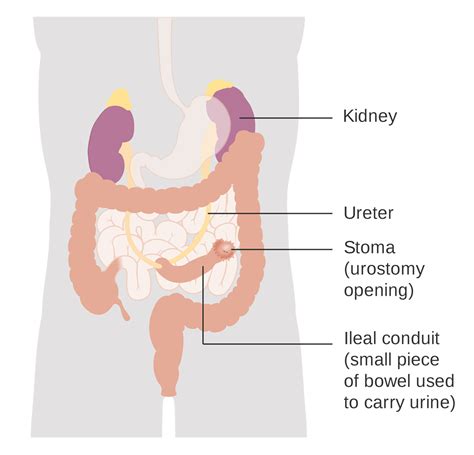 Ileal Conduit