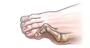 Hammer Toe - Symptoms, Causes, Treatment and Rehabilitation