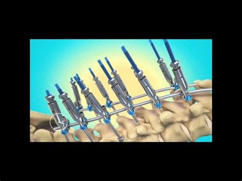 Kyphosis - Surgical Correction with Instrumentation - YouTube