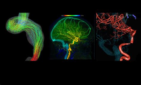 Pulsatile Tinnitus Causes and Treatments | UCSF Radiology