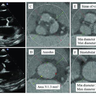 Pre-procedural transthoracic echocardiogram (TTE) and multidetector ...