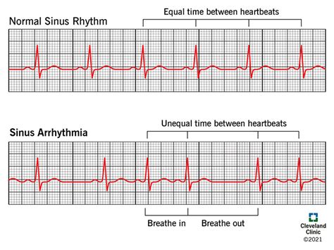 Sinus Arrhythmia: Causes, Symptoms and Treatment