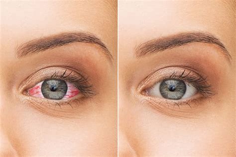 Dry Eye Syndrome: 10 Home Remedies To Cure It - YeyeLife