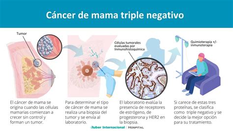 Tratamiento del cáncer de mama