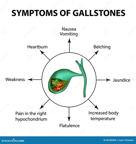 Symptoms of Stones in the Gallbladder. Infographics Stock Vector ...