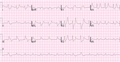 Dr. Smith's ECG Blog: Hyperkalemia and ST Segment Elevation, Post 1