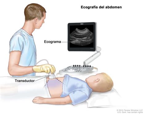 Tratamiento del neuroblastoma