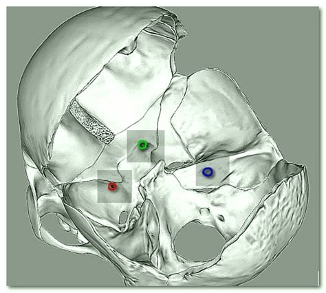 Foramen Rotundum - Contents, Location, Function