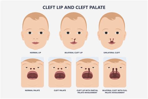 What Causes Cleft Lip And Palate In Babies And Treatment - UsParenting.com