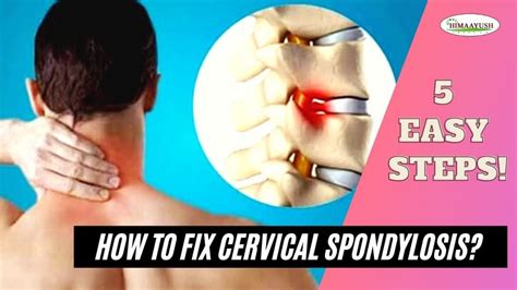 Cervical Spondylosis relief with 5 Easy exercise & home remedies