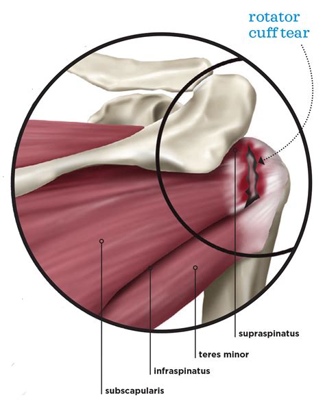 Rotator Cuff Anatomy