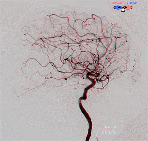 Middle Meningeal Artery | neuroangio.org