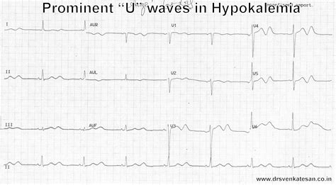 Hypokalemia Ecg