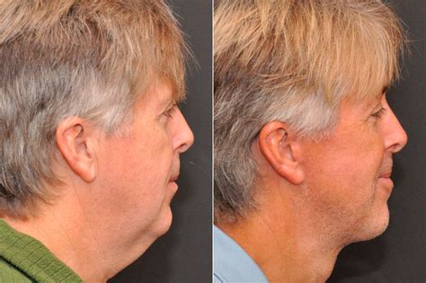 Minilift / Facelift Photos | Cincinnati, OH | Patient 8102