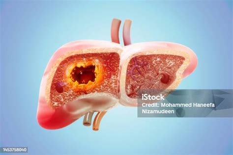 Liver Cancer Or Liver Tumor Hepatocellular Carcinoma Causes Symptoms ...