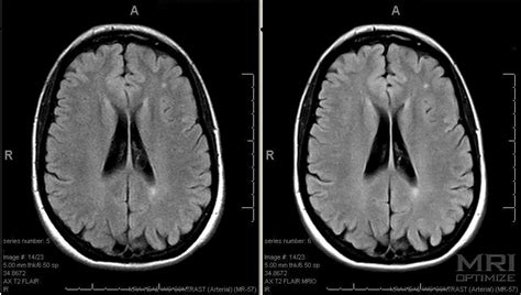 Normal Brain Mri Axial Flair