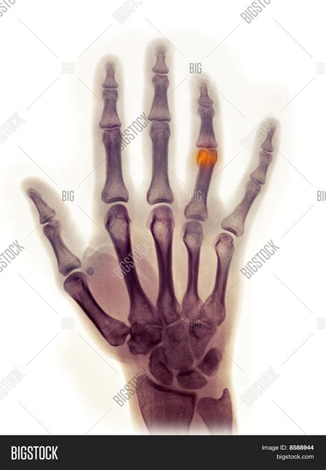 Hand X-ray 23 Year Old Image & Photo (Free Trial) | Bigstock