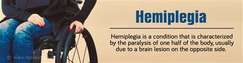 Hemiplegia - Causes, Symptoms, Diagnosis, Treatment and Prevention