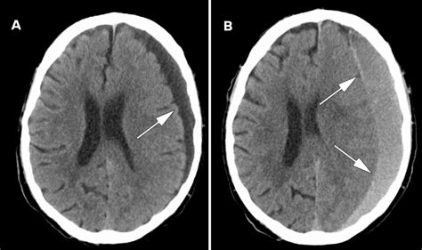 Subdural Hemorrhage CT Scan