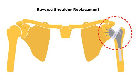 Reverse Shoulder Replacement FAQ's: Dr McClintock Roseville CA