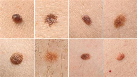 Understanding the different types of moles | Spot Check Clinic