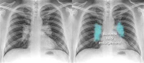 Hilar Congestion Chest X Ray