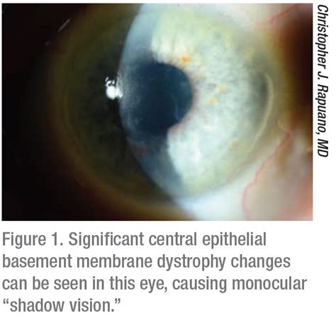 What Causes Anterior Basement Membrane Dystrophy - Openbasement