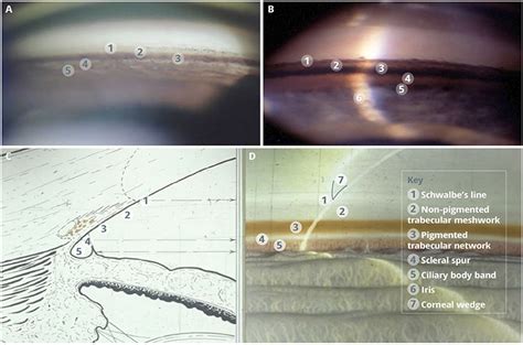 Community Eye Health Journal » Gonioscopy skills and techniques