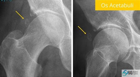 HIP MRI? SHOW ME THE XRAY: ACETABULAR RIM OSSIFICATIONS. HOW TO MAKE ...