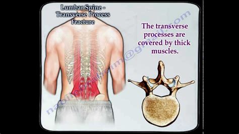 Lumbar Spine Transverse Process Fracture - Everything You Need To Know ...