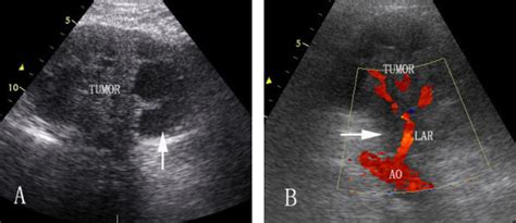 Kidney Tumor Ultrasound