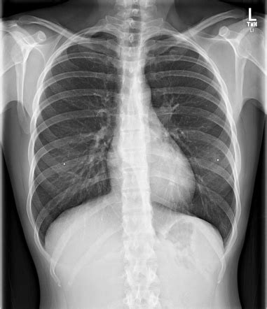 Esophageal duplication cyst | Radiology Case | Radiopaedia.org