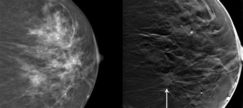 What Is 3D Mammography? | Duke Health