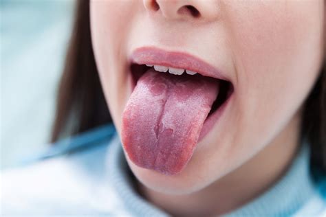 Geographic Tongue – Causes, Symptoms & Treatment London