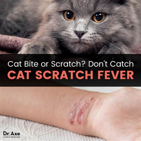 How to Prevent Cat Scratch Fever + Natural Symptom Relief | Best Pure ...