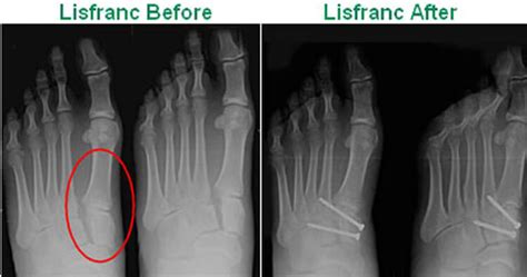 Diagnosis Of A TMT Joint Injury | Sydney Physio Clinic