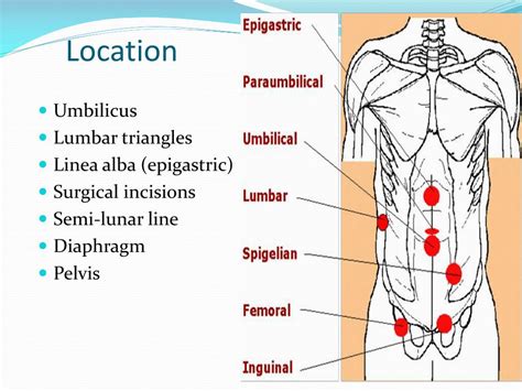 PPT - hernia PowerPoint Presentation, free download - ID:2957512